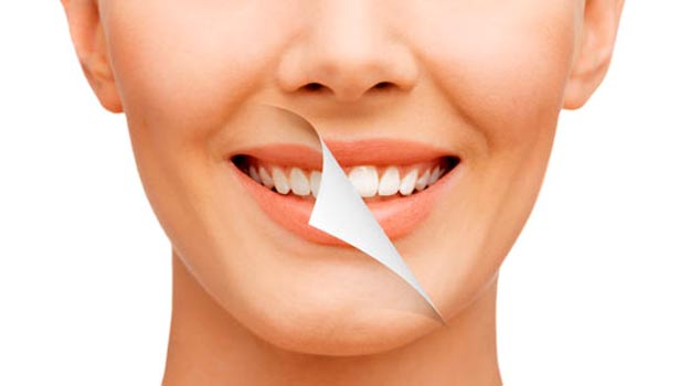 Teeth-Whitening