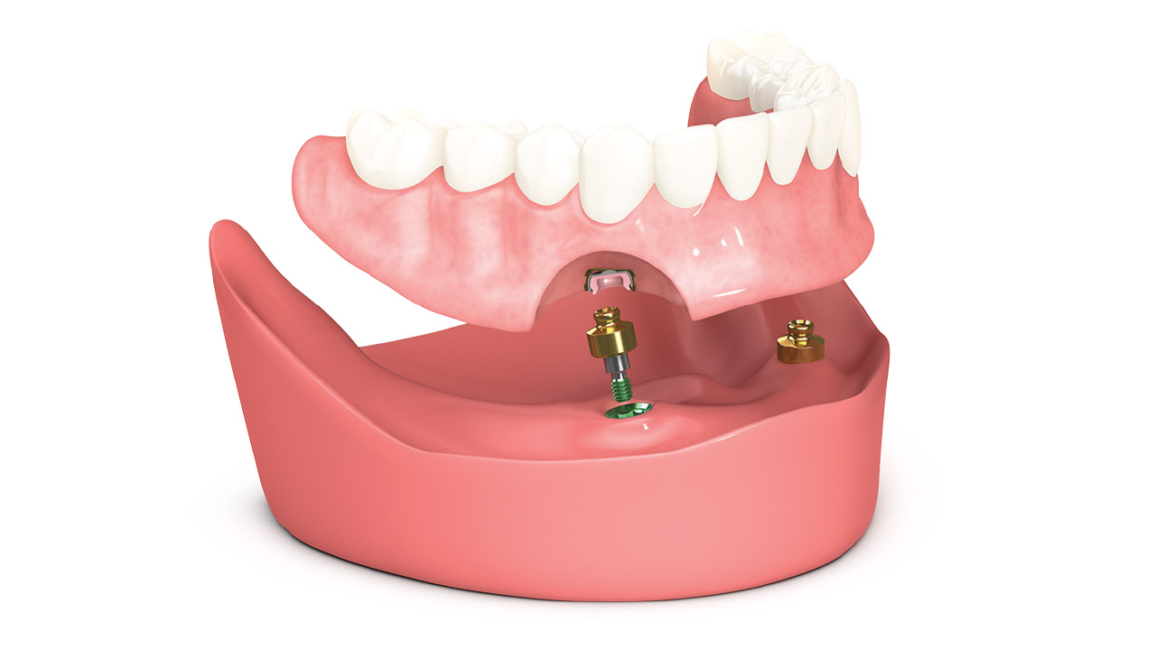 Overdenture