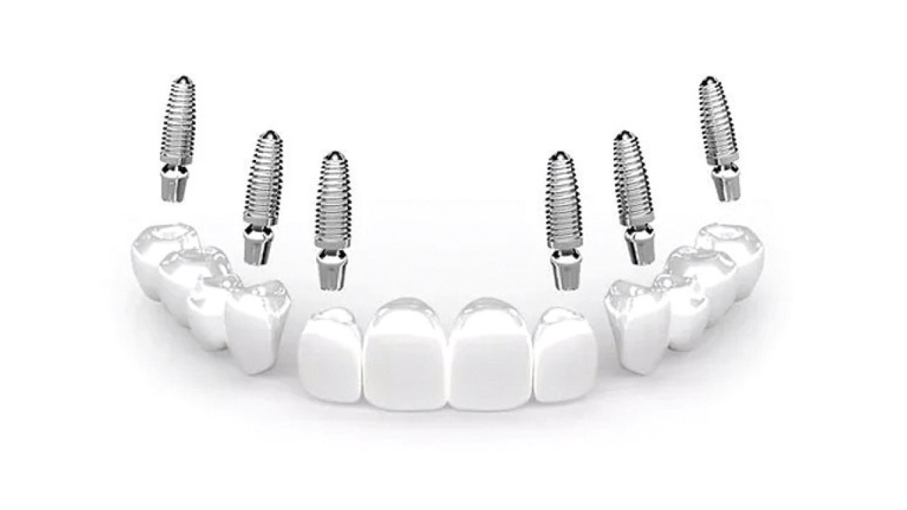 Full Arch Fixed Implant Bridge