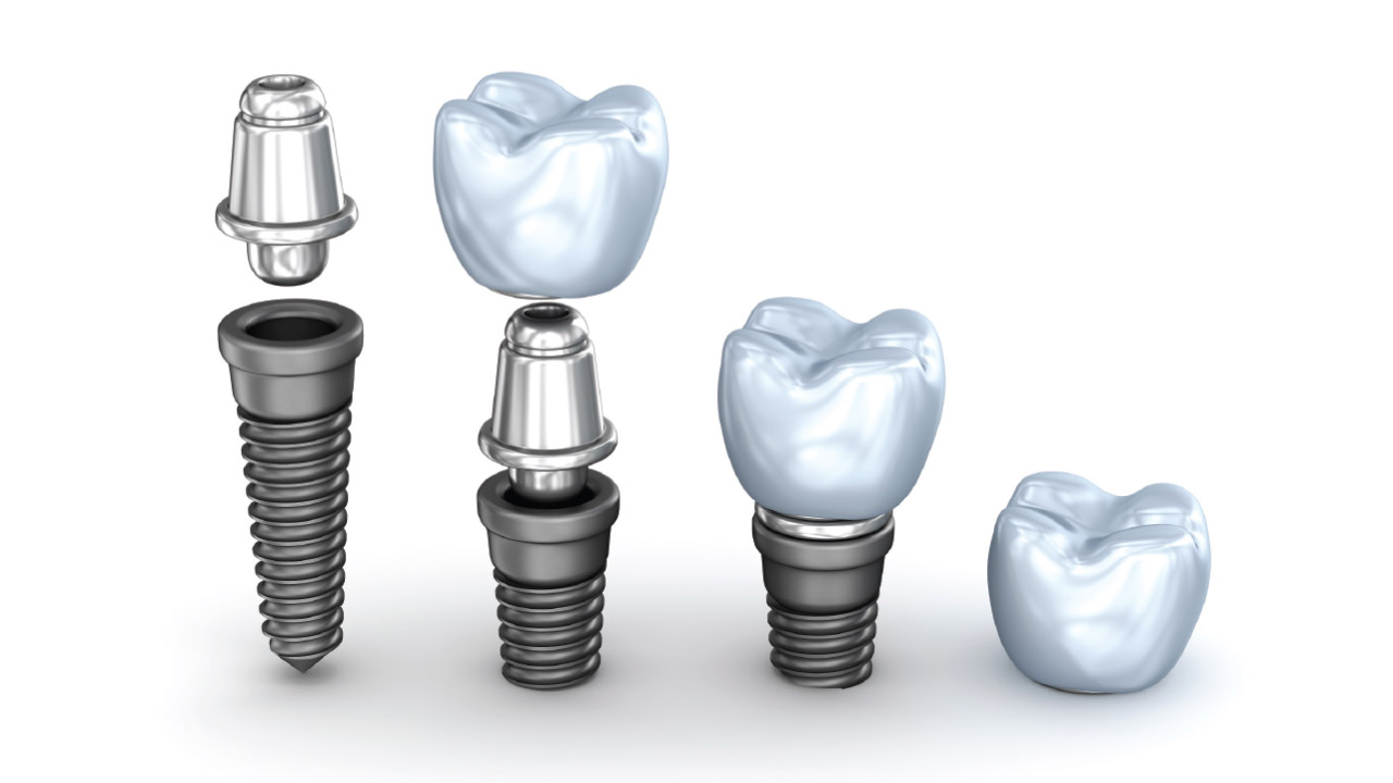 Single Tooth Dental Implant