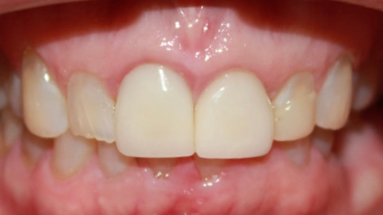 Advanced acid erosion and reduced vertical dimension